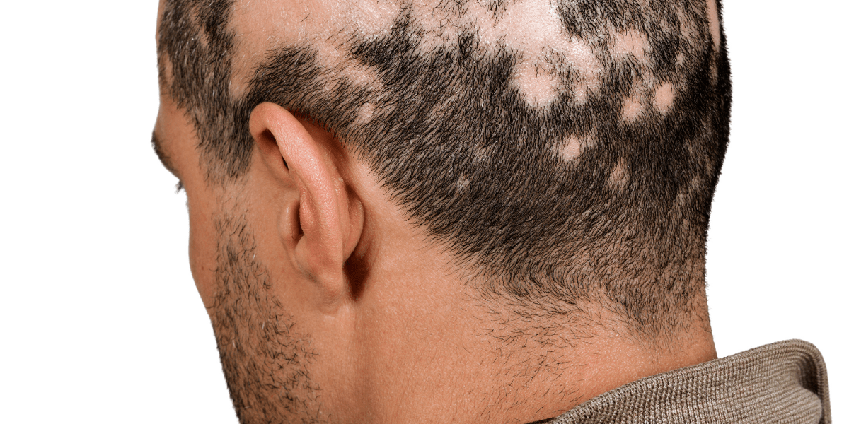 A man with alopecia areata