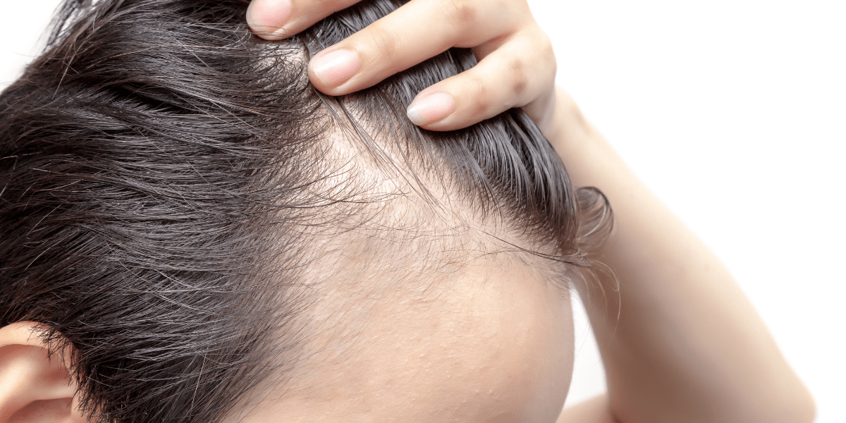 A woman with hair loss