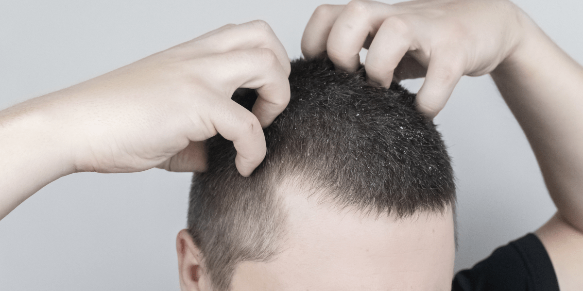 A man with scalp itching