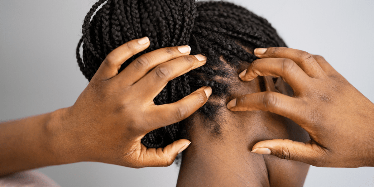 A woman with minoxidil itchy scalp