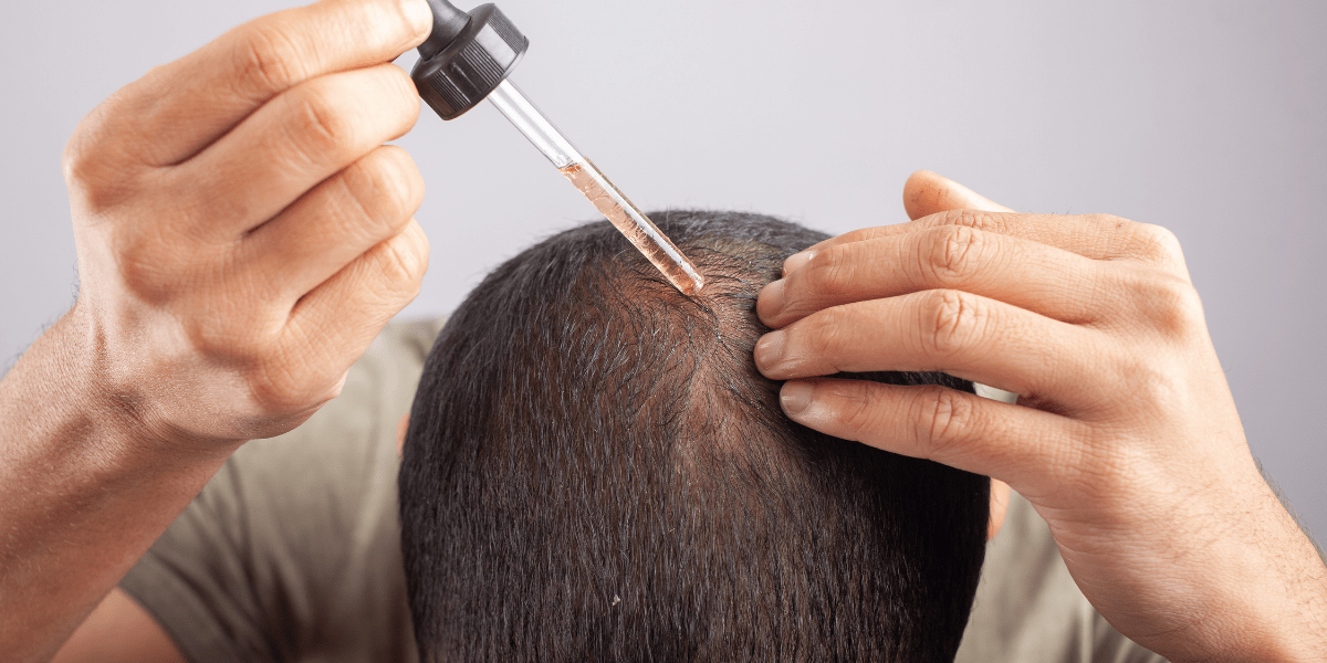 A man applying minoxidil liquid to his scalp.