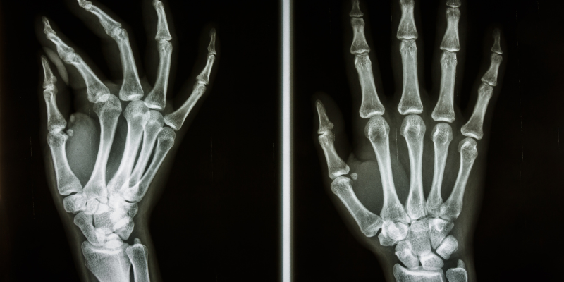decreased bone density