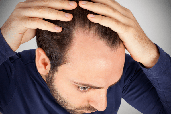 man with receding hairline How Long Does It Take For Minoxidil To Work