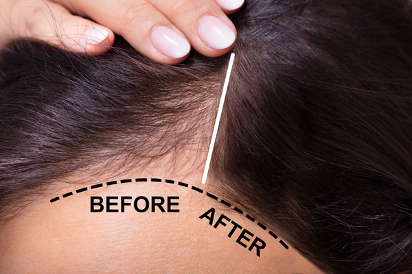 hair loss treatment