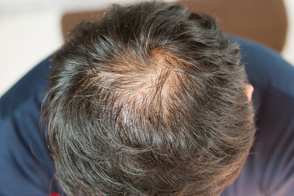 a balding man