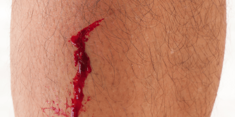 A cut on a person's leg.