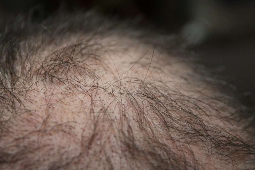 Minoxidil foam vs. liquid for hair loss