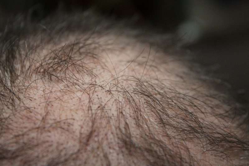 Hair Loss Finasteride Interactions
