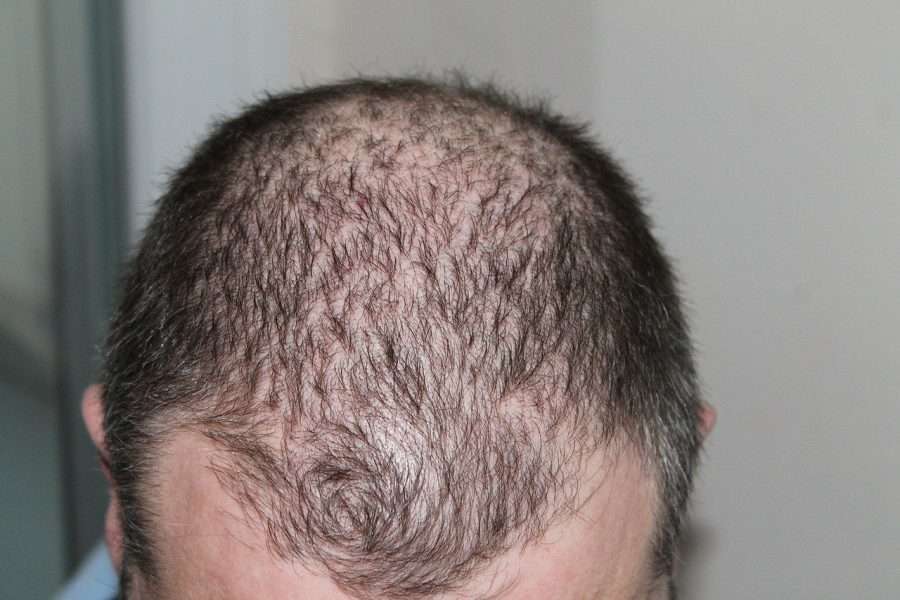 Male Pattern Hair Loss