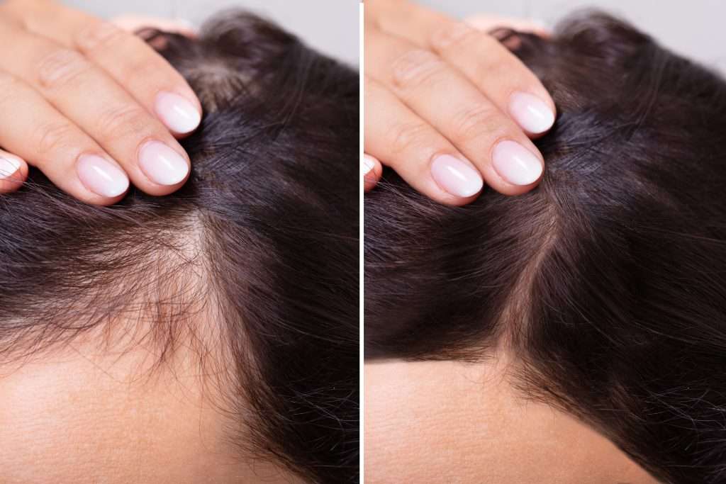 Close up of before and after with hair growing back