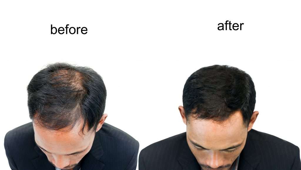 Before after hair growing back